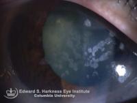 Granular dystrophy and recurrent dystrophy post penetrating keratoplasty.